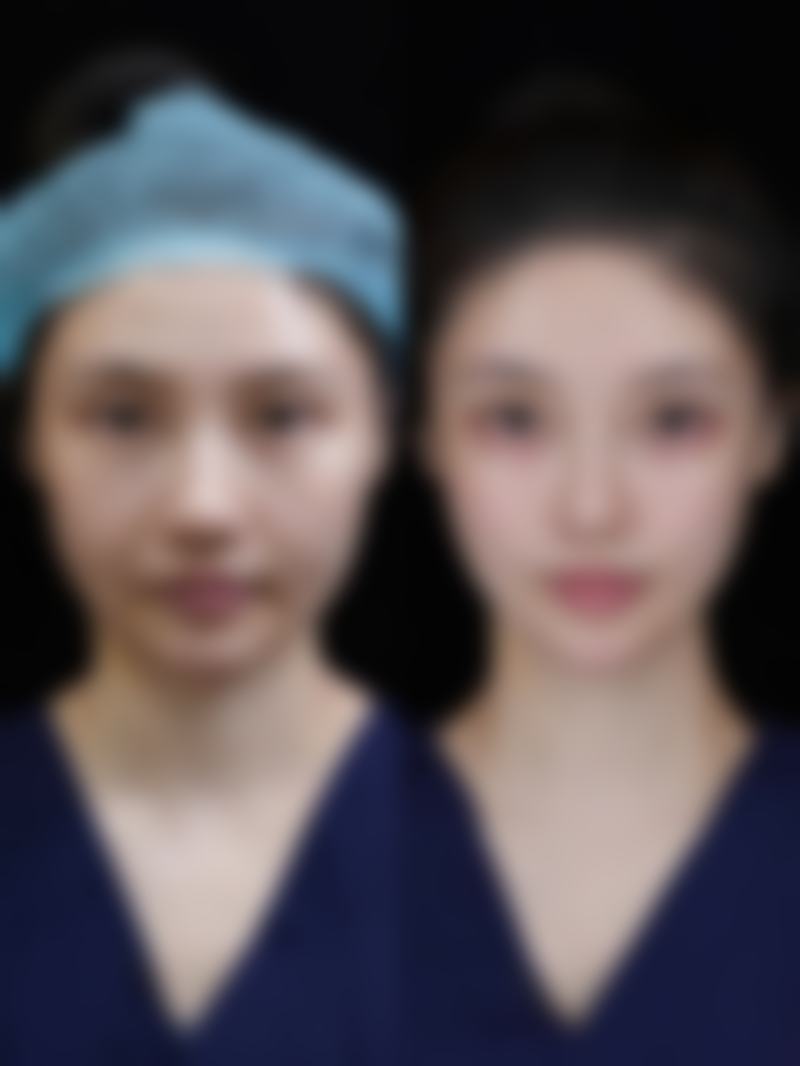 线提升隆鼻术后需要注意什么