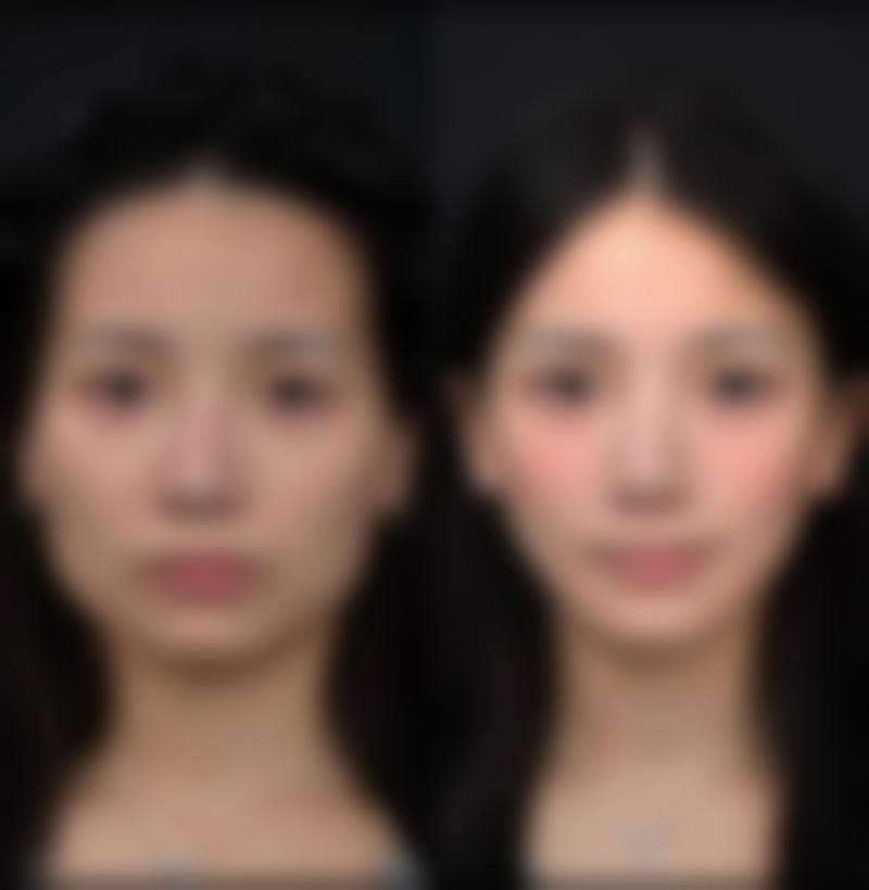 隆鼻修复期的阶段划分