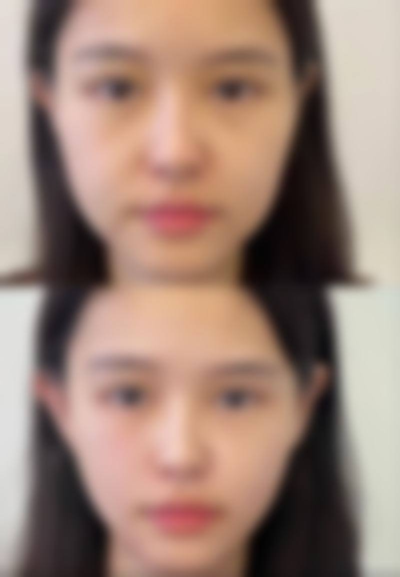 术后热敷特别关键