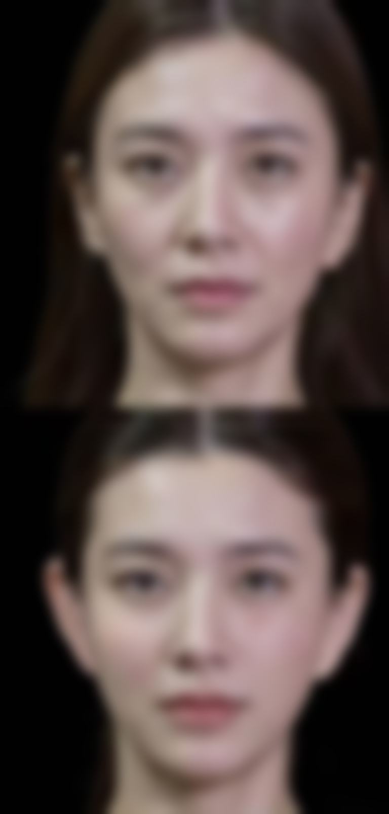 总结隆鼻需要多久的修复期