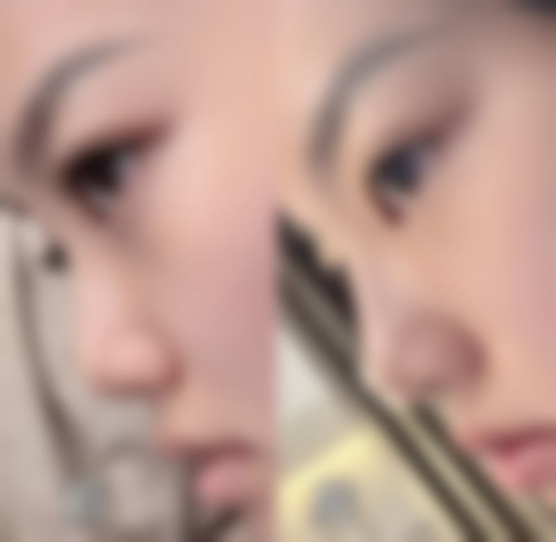 祛眼袋出现凹陷下去该怎么办