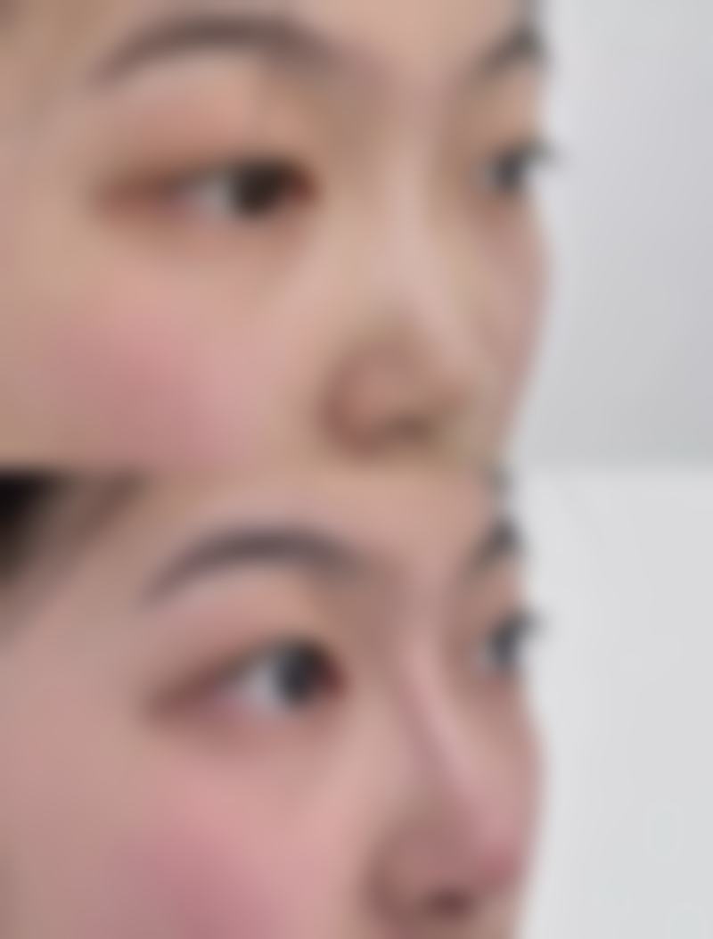 隆鼻需要多久的恢复期？注射几天到一周 自体1 - 2个月 假体半年左右 