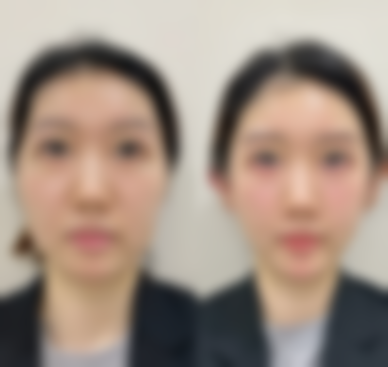 做双眼皮可能面临的具体危险