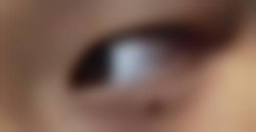 自体耳软骨隆鼻维持时间总结