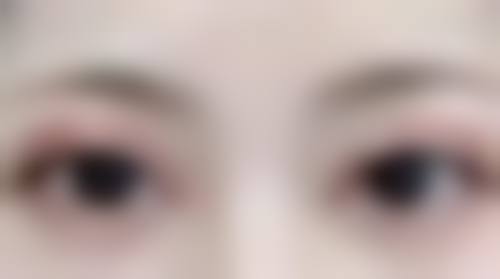 打瘦脸针的其他注意事项