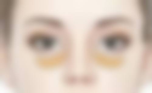 不同手术方式下双眼皮割要多久时间
