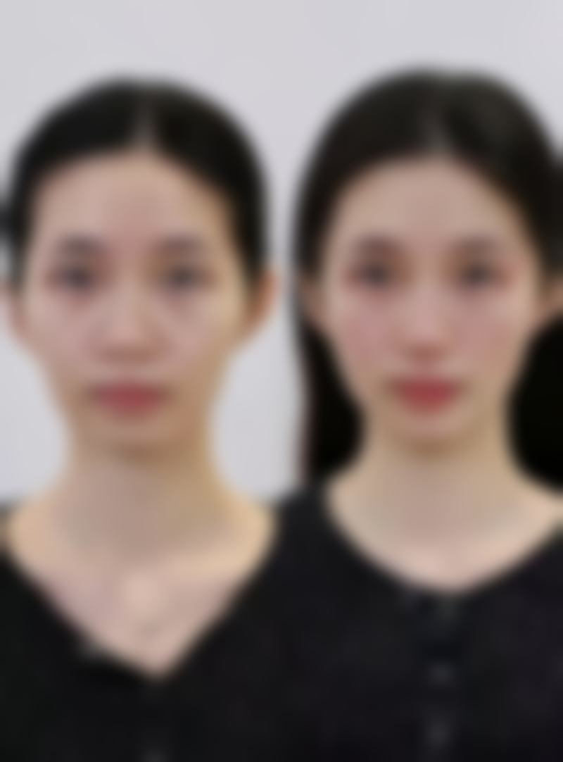 面部吸脂戴多久头套？术后1 - 2周24小时戴，3周后至1 - 3个月按需调整