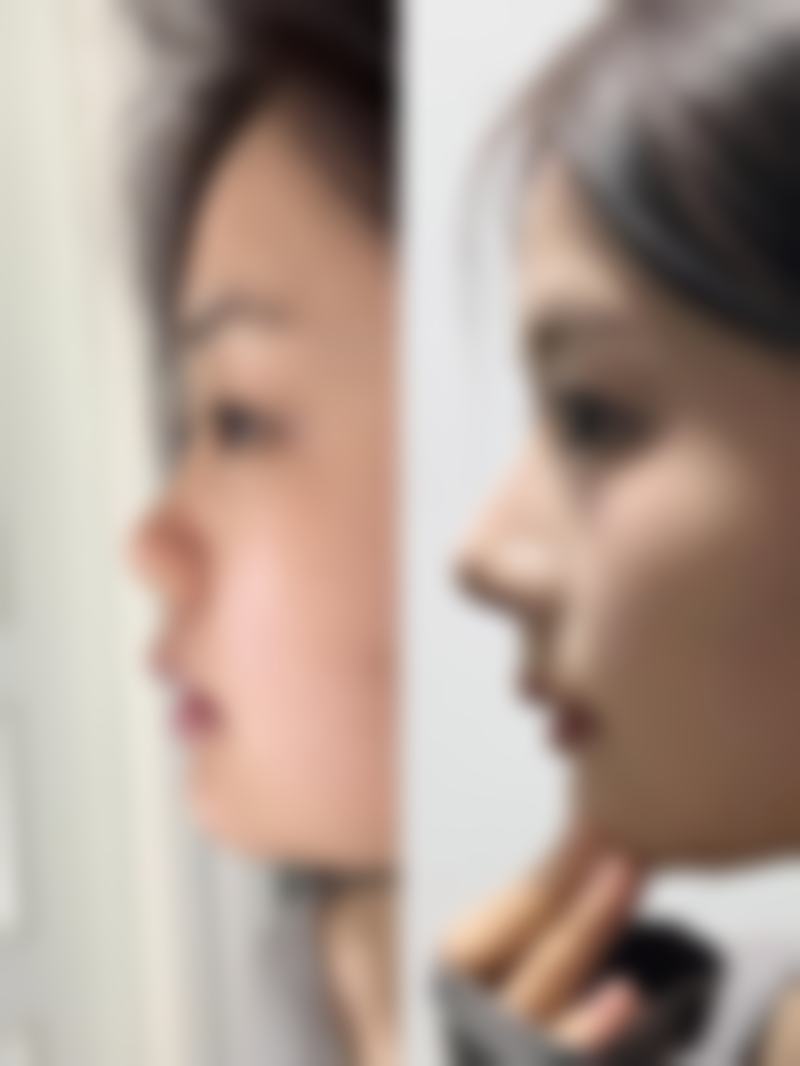 放射治疗怎样治疗凸起型疤痕