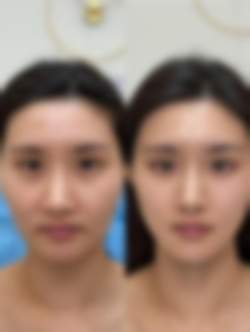 使用熊猫针的成效及维持时间