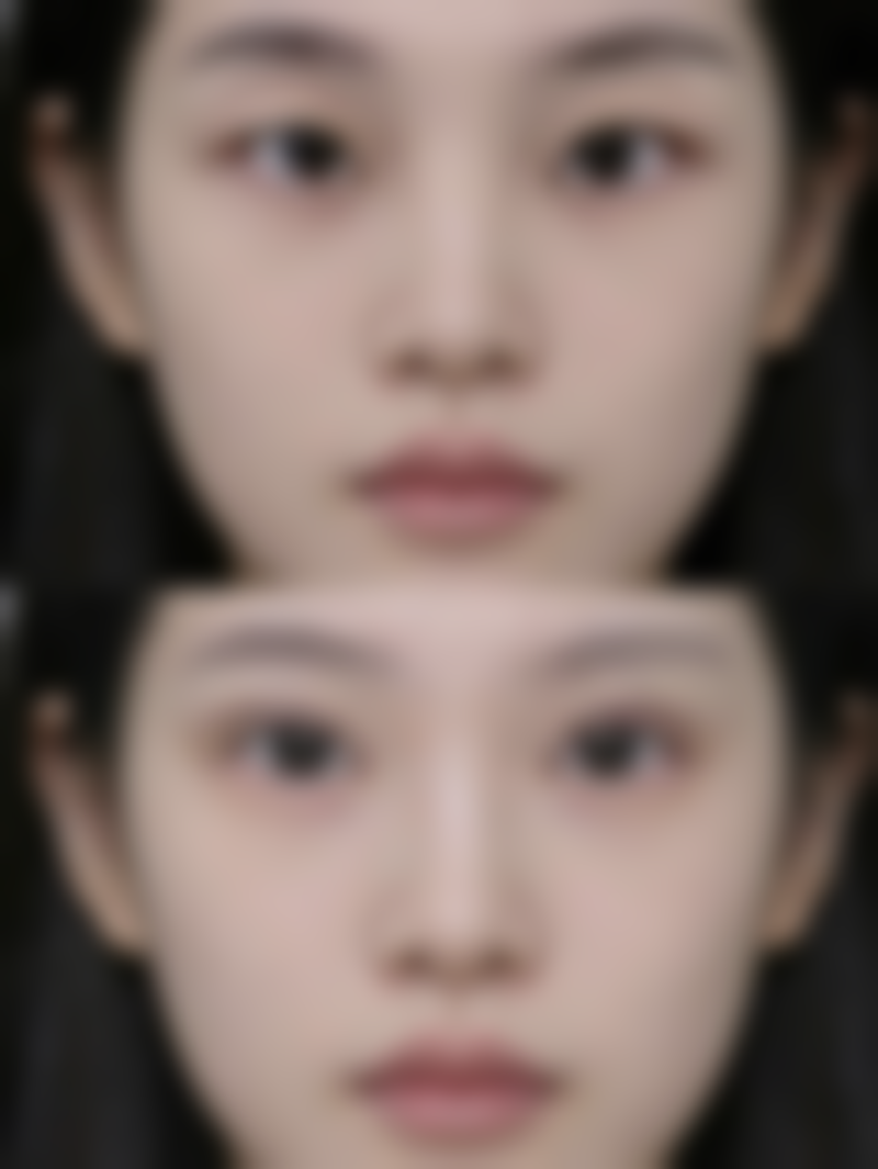 fotona去眼袋适合哪些人呢