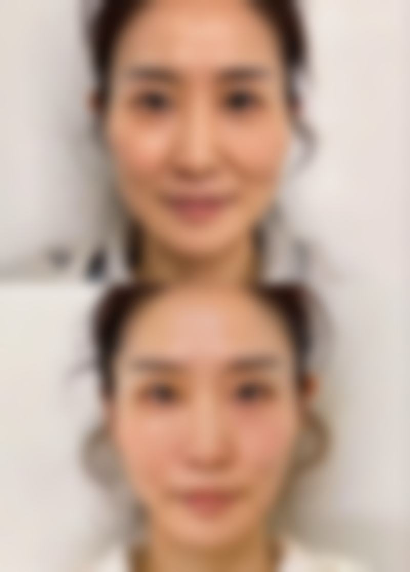 影响开胸手术疤痕修复时间的因素
