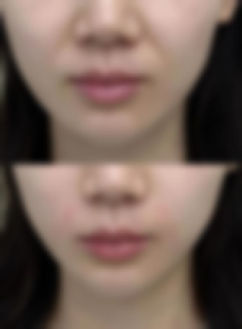 抽脂后的注意事项