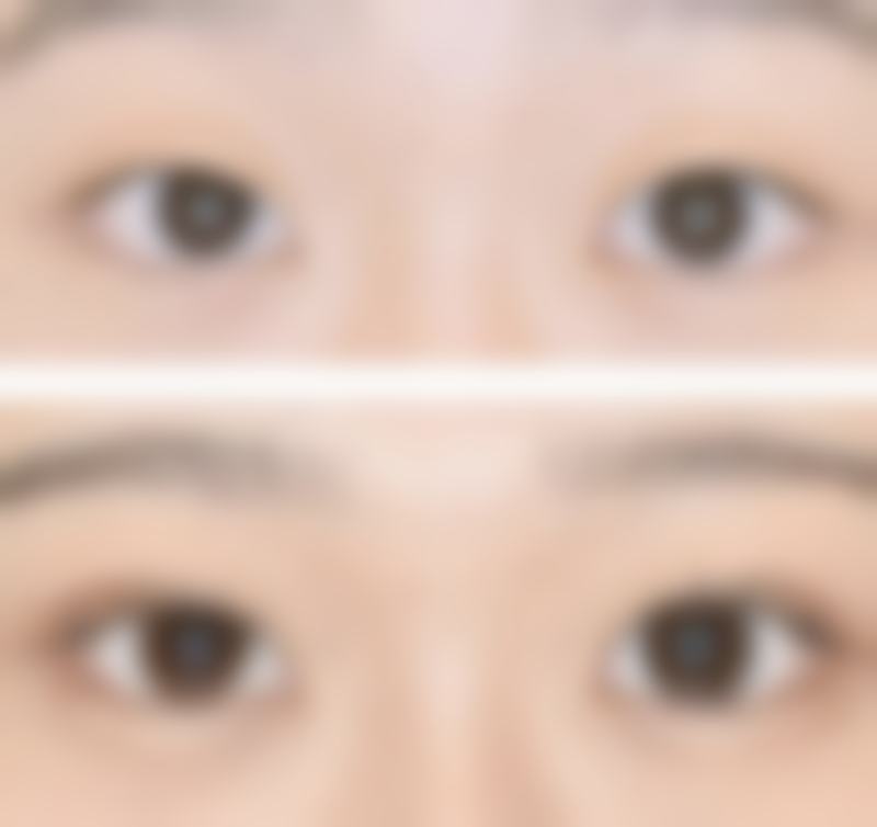 保妥适除皱的成效怎么样