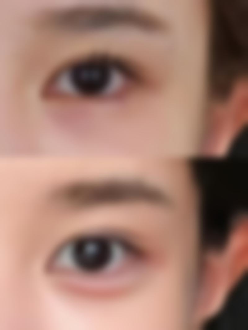 眼袋形成的原因