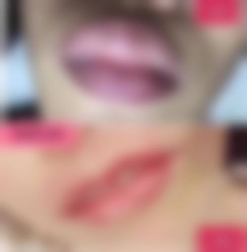 埋线双眼皮眼睛发紫是否正常