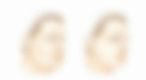 影响假体隆胸维持时间的因素