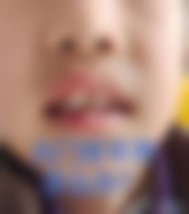 预约优惠活动 黄轶苏州美莱口腔预约