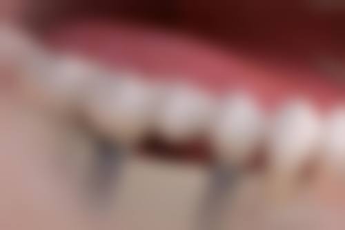 四、吴忠陈富口腔诊所开展的项目以及特色项目