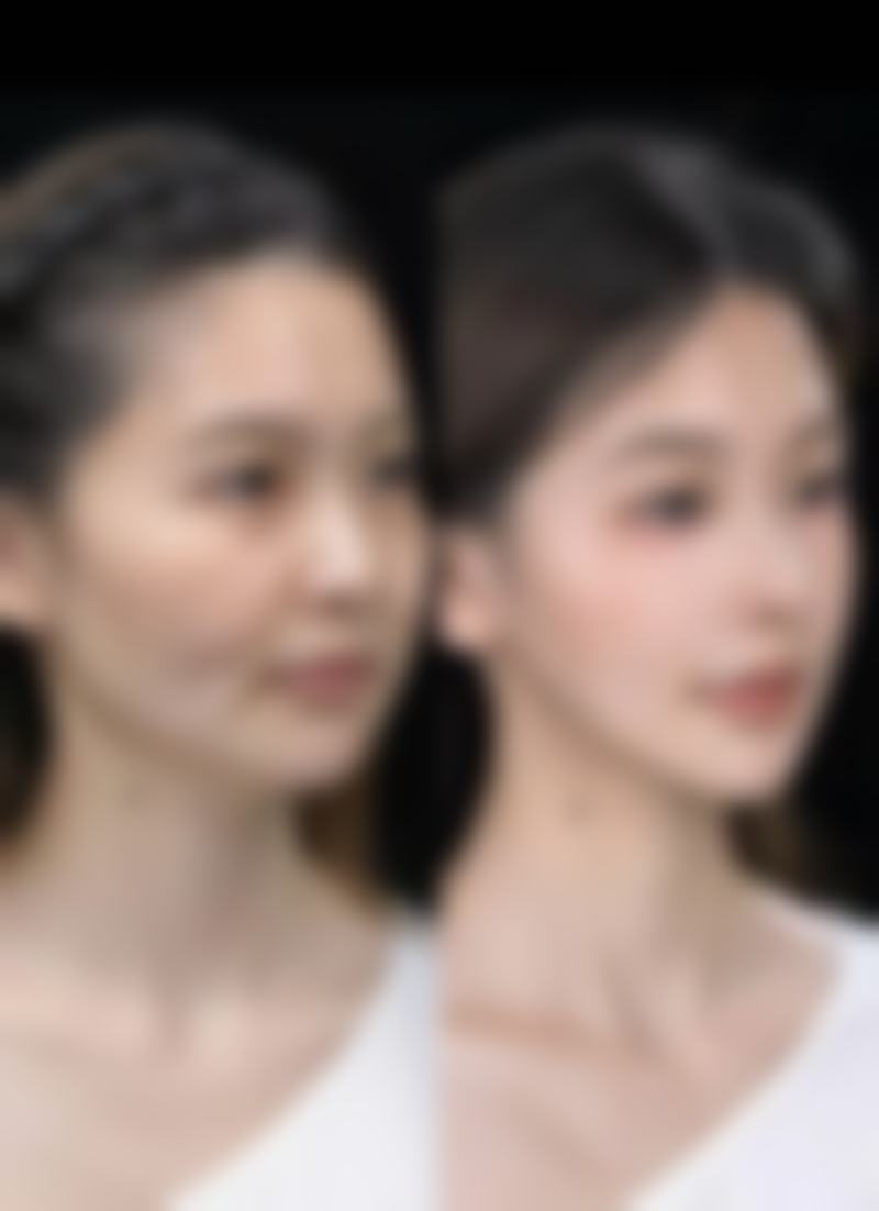 隆鼻过程中需要注意的操作事项